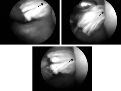Artroskopowy obraz rozerwanej endoprotezy Leeds-Keio (C. Z., nr hist. choroby 3254/07) rekonstrukcja w 1995 roku (strzakami oznaczono przyczep udowy endoprotezy)