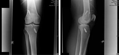 RTG pooperacyjne zrekonstruowanego wizada krzyowego przedniego z uyciem endoprotezy Lars (S.R. nr hist. choroby 9571/08)