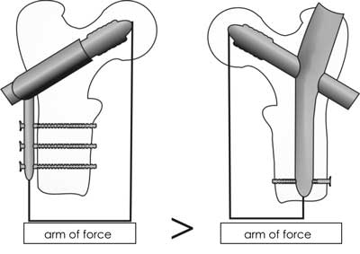 The biomechanics of DHS and intramedullary nail fixation for trochanteric fractures