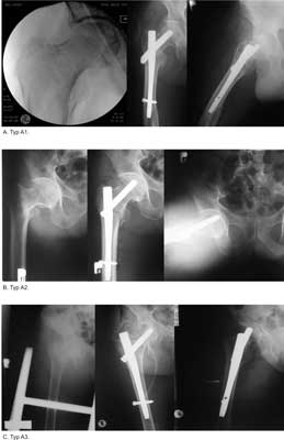 Examples of fractures fixed with intramedullary nail (A) AO type A1.1 (W.M.), (B) AO type A2.2 (B.C.), (C) AO type A3.2 (W.K.)
