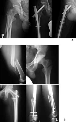 Fractures fixed with long Gamma nail (A) fracture with long oblique fissure extending much below smaller trochanter (Z.P.), (B) Multilevel fracture (reversed trochanteric fracture with fracture of femoral shaft (S.G.)