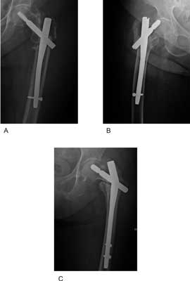 Selected complications of intremedullary fixation for trochanteric fractures: (A) non-union (M.W.), (B) nail migration (D.J.), (C) failure of the nail (M.Z.)