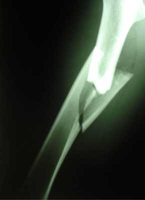 Fragmented fracture of the femoral shaft, day of injury