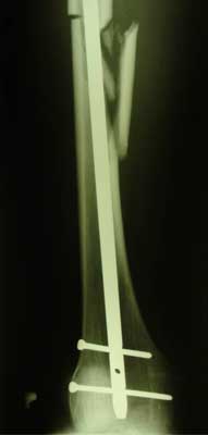 Fragmented fracture of the femoral shaft, 11 days after injury