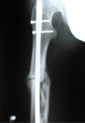 Fragmented fracture of the femoral shaft, 3.5 months after injury