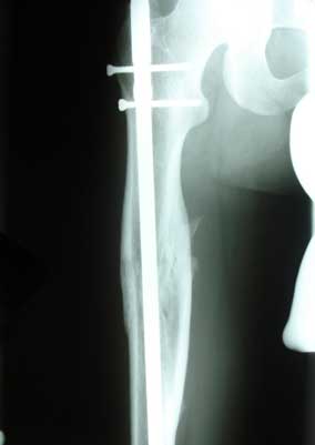 Fragmented fracture of the femoral shaft, 25 months after injury