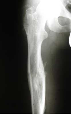 Fragmented fracture of the femoral shaft, 25 months after injury
