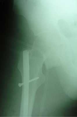 Multifragmentary fracture of the femoral shaft, 5 days after injury