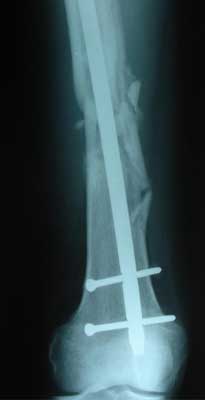 Multifragmentary fracture of the femoral shaft, 1.5 months after injury