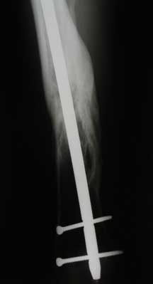 Multifragmentary fracture of the femoral shaft, 13 months after injury