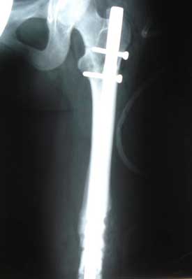 Transverse femoral shaft fracture, 4 months after injury