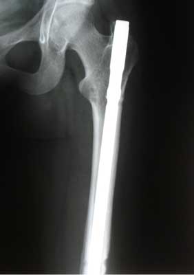 Transverse femoral shaft fracture, 8 months after injury